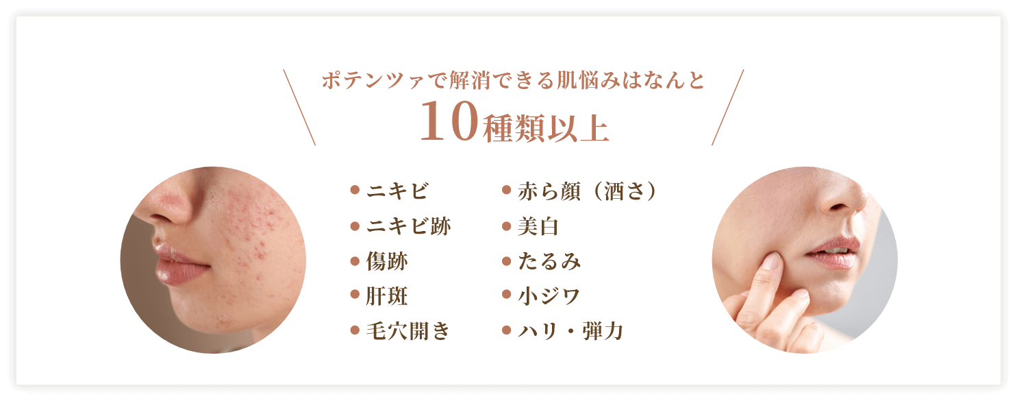 ポテンツァで解消できる肌悩みはなんと10種類以上