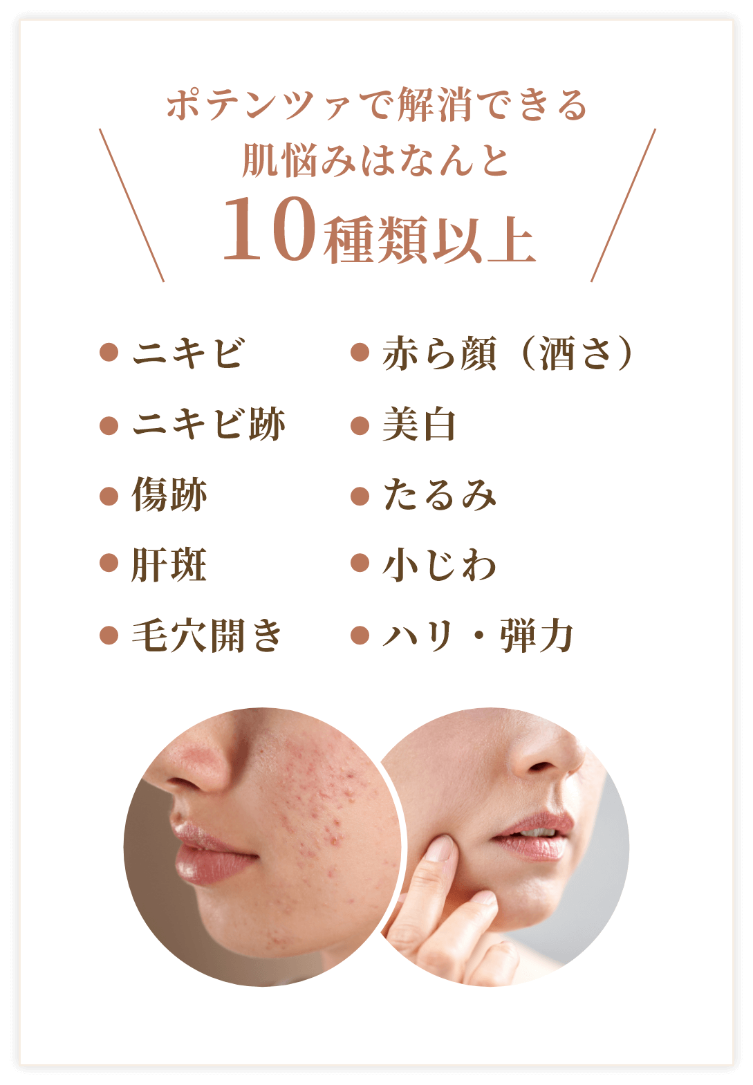 ポテンツァで解消できる肌悩みはなんと10種類以上